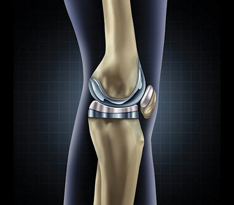 joint knee replacement-462x405web